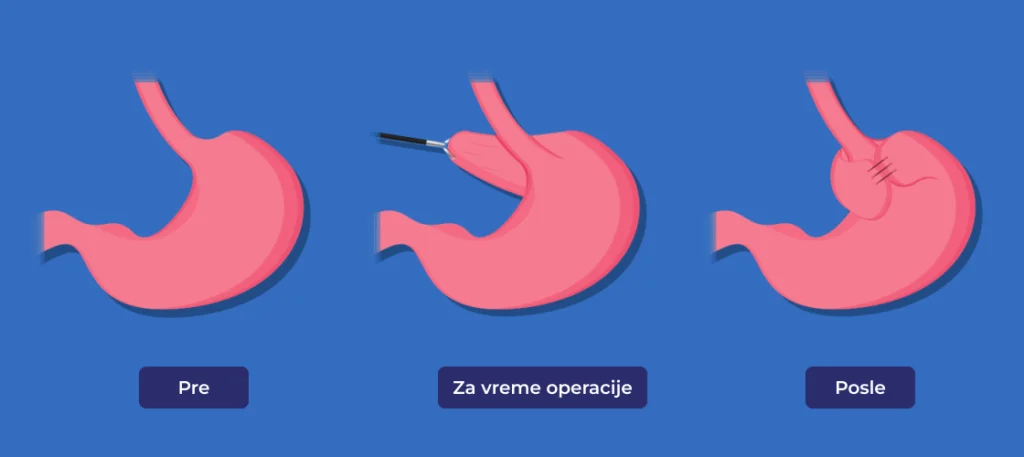 Osnovni princip fundoplikacije